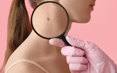 Gyakori kérdések az anyajegyről – Mikor szükséges orvoshoz fordulni?